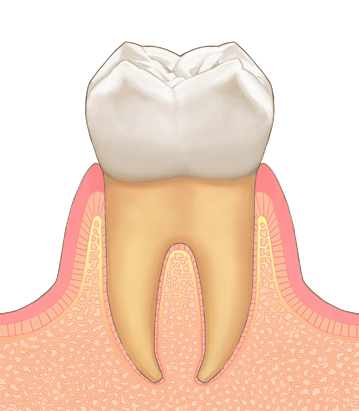 歯周病の進行①
