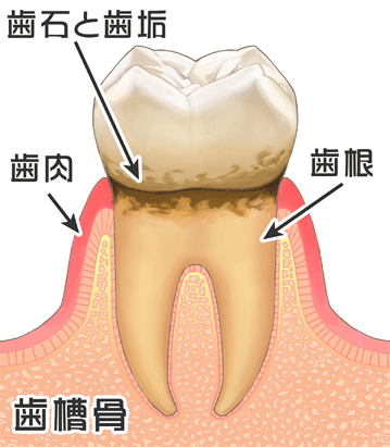 歯周病の進行②