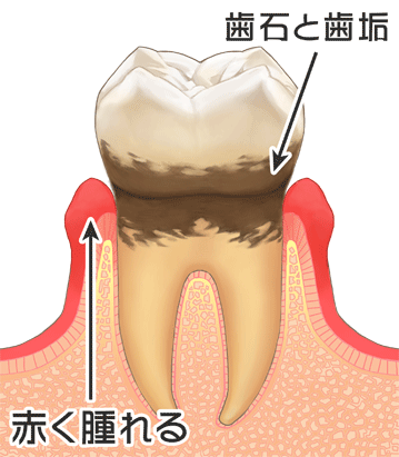 歯周病の進行③