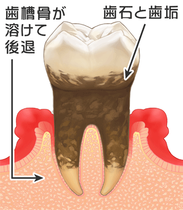 歯周病の進行④